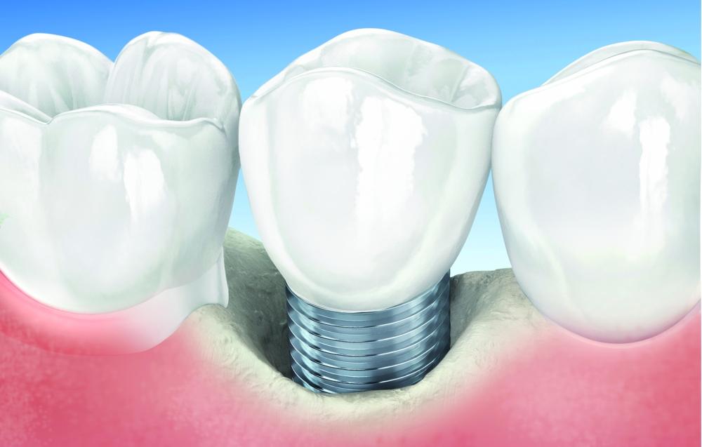 Regenerative Treatment Of Peri-Implantitis